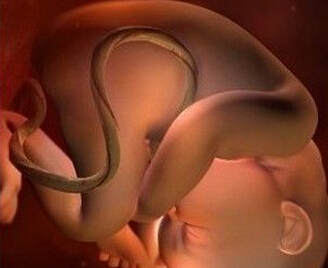 胎儿脐带绕颈怎么办 孕晚期胎儿脐带绕颈怎么办