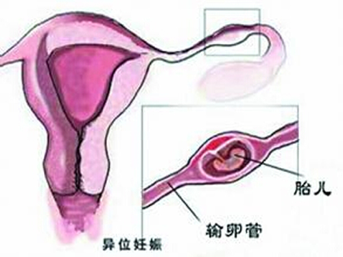 宫外孕是怎么引起的 宫外孕是怎么引起的原因是什么