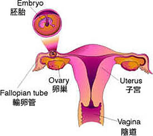 什么是宫外孕 什么是宫外孕图片