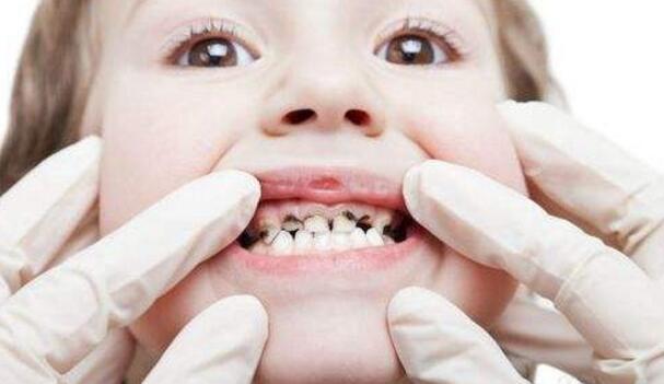 如何保护牙齿预防蛀牙（如何保护牙齿预防蛀牙的方法）