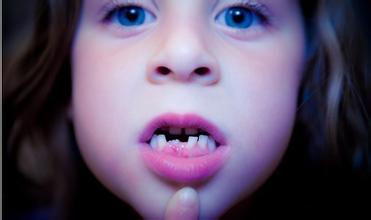 儿童换牙期注意事项 儿童换牙期注意事项有哪些