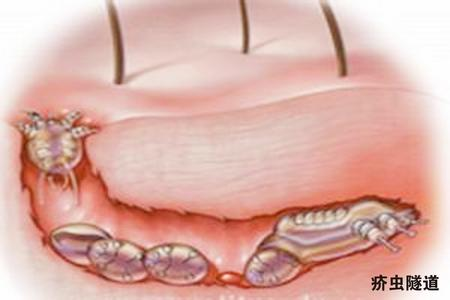 疥疮是怎么引起的（疥疮是怎么引起的如何治疗）