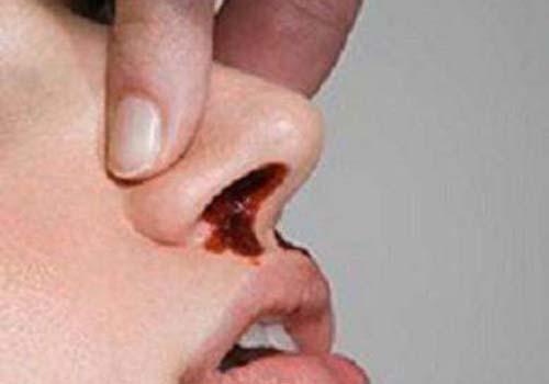 流鼻血是什么引起的 13岁男孩流鼻血是什么引起的
