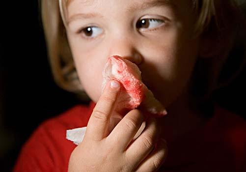小孩流鼻血是什么原因 小孩流鼻血是什么原因怎样快速止血