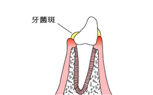 牙周炎是什么原因引起的（牙周炎是什么原因引起的怎样防治）