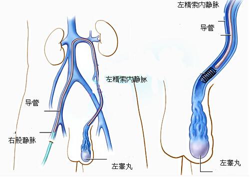 老怀不上竟是因为精索静脉曲张 为什么精索静脉曲张会导致不孕