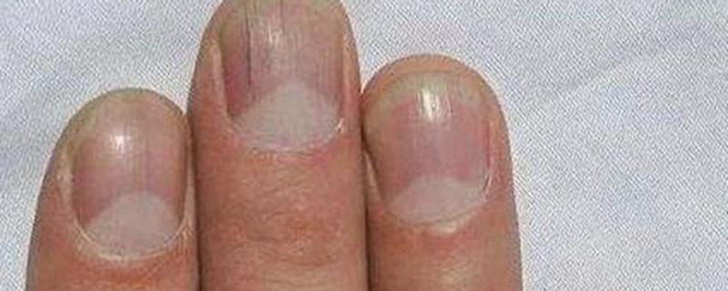 指甲有竖纹是身体什么信号 指甲有竖纹应该吃什么
