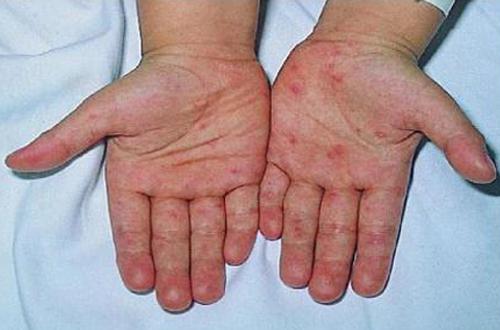 手足口病初期症状（手足口病初期症状与治疗）