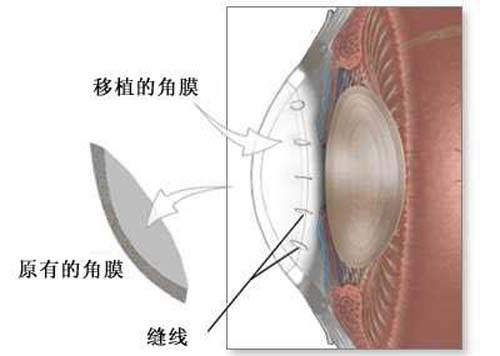 眼角膜是什么 眼角膜是什么颜色