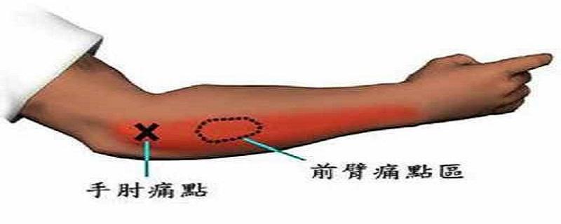 网球肘艾灸要哪个位置 网球肘艾灸部位图片