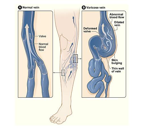下肢静脉曲张有什么危害 下肢静脉曲张有什么危害和后果