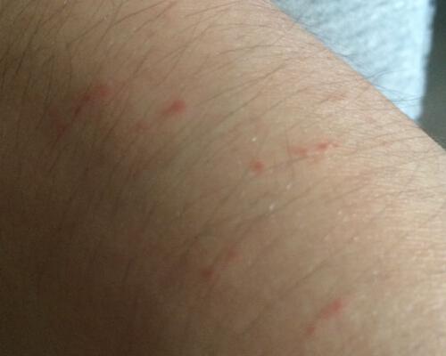 被蚊子咬了起红点怎么回事 被蚊子咬了起了红点是什么症状