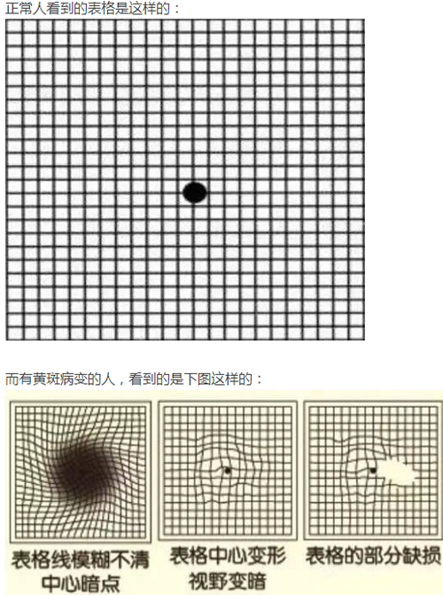 眼睛看东西变形扭曲是什么原因 眼睛看东西变形扭曲是什么原因,治疗好了,还会复发吗