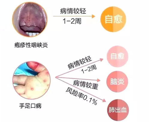 疱疹性咽峡炎和手足口病的区别（小儿疱疹性咽峡炎和手足口病的区别）