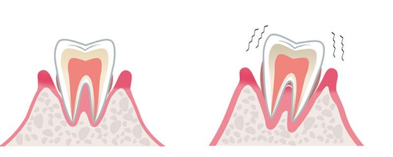 缓解牙疼的8个简单方法 智齿缓解牙疼的8个简单方法