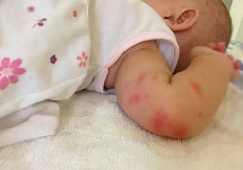 宝宝被蚊子叮了有疤自己会消吗 宝宝被蚊子叮了会留疤吗