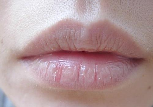嘴巴脱皮是什么原因 嘴巴脱皮是什么原因造成的