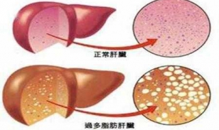 轻度脂肪肝怎么办 可以了解这些方法