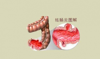 得了结肠炎怎么办 有这样三种治疗方法