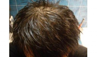 油脂性脱发怎么办 希望能够给你们带来一定的帮助