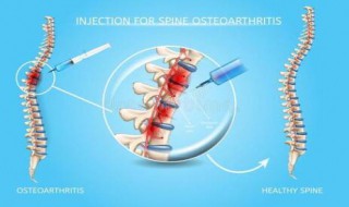 脊柱关节炎的早期症状是什么 饮食保健方法需了解