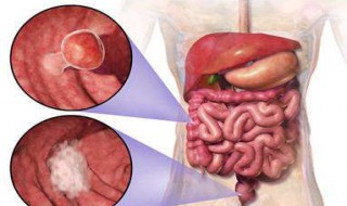 直肠癌的6个早期症状 别错当成了痔疮或胃病