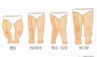 学生0型腿怎么矫正 小宝宝o型腿矫正最有效的方法