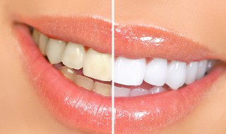 牙齿变白的有效方法窍门 牙齿变白的有效方法窍门是什么
