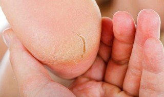 手脚皮肤皲裂快速修复方法（手脚皮肤裂开是什么原因）