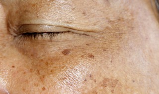老年斑是怎么形成的 老年斑是怎么形成的怎么预防和治疗
