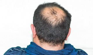 7种有效应对秃顶的方法是什么 7种有效应对秃顶的方法是什么意思