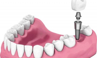 牙齿修复方法 牙齿修复方法有几种