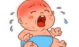 宝宝的湿疹怎么护理 宝宝的湿疹怎么护理啊
