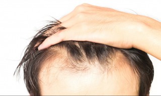 怎样防止掉头发 怎样防止掉头发男