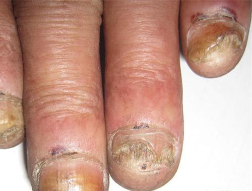 灰指甲的初期症状（灰指甲的初期症状图片）