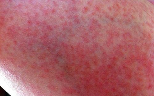 如何治疗皮肤过敏 如何治疗皮肤过敏?