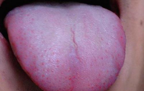 艾滋病初期舌头症状（艾滋病初期舌头症状是什么样的）