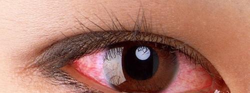 眼睛红血丝是怎么回事 戴隐形眼睛红血丝是怎么回事