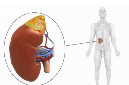 肾炎的早期症状 肾炎的早期症状表现有哪些女