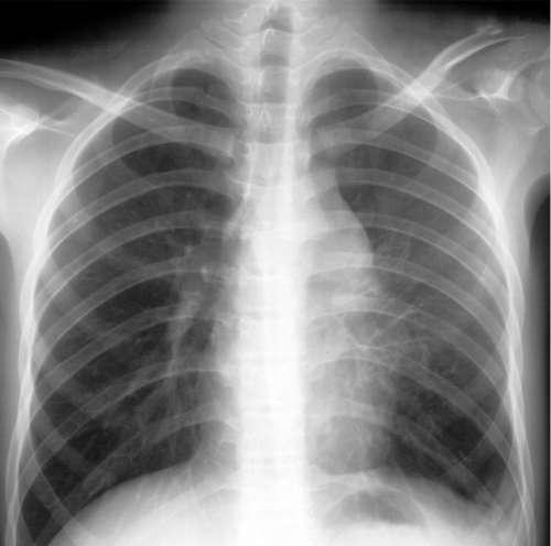 肺纹理增多 肺纹理增多能自愈吗