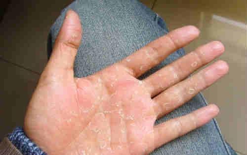 季节性手脱皮 季节性手脱皮是什么原因