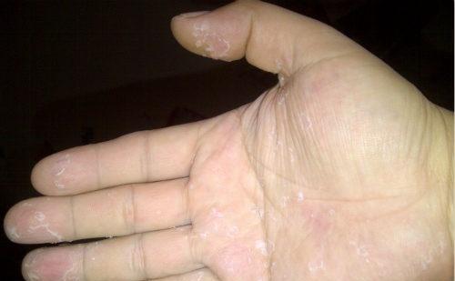 手指脱皮是什么原因 手指脱皮是什么原因吃什么维生素