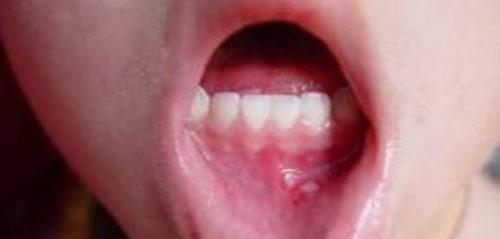 口腔溃疡的偏方 口腔溃疡的偏方是什么