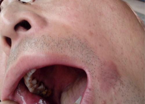 口腔白斑病的偏方 治疗口腔白斑的偏方