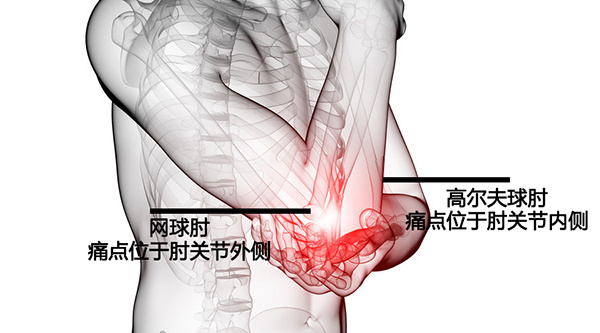 网球肘的病症特征介绍 饮食保健对网球肘的治疗