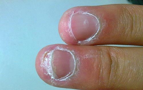 治疗灰指甲的最佳方法
