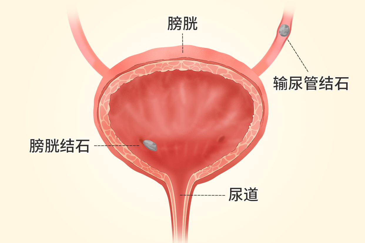 男生膀胱结石在什么位置图片 男性膀胱结石的部位图片