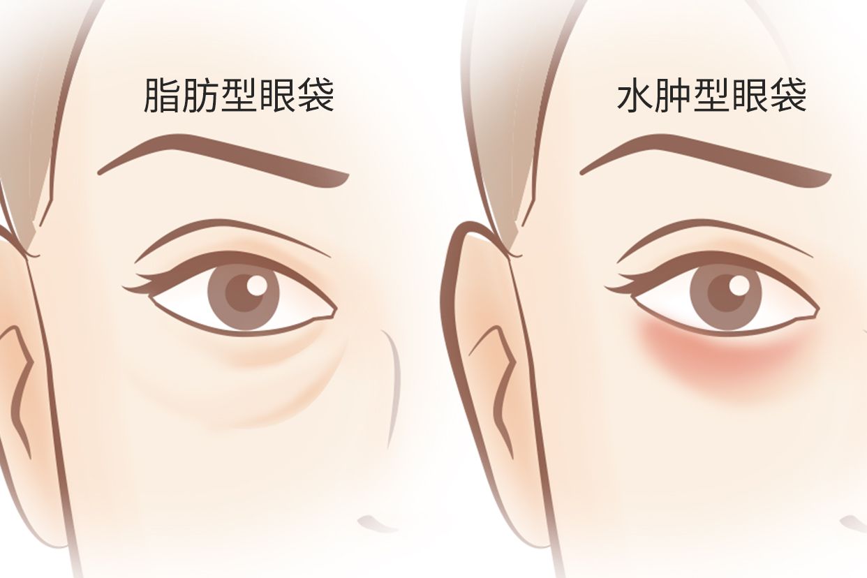 脂肪型眼袋和水肿型眼袋区别图（脂肪型眼袋特点）