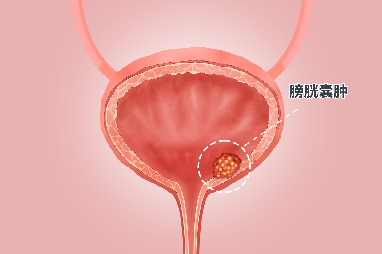 膀胱囊肿图片 膀胱囊肿图片高清