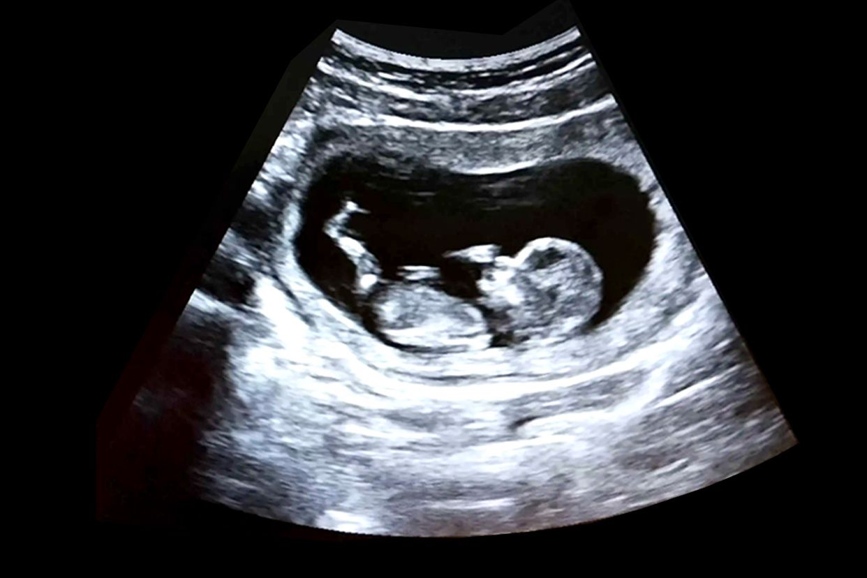 nt的胎儿图片可以看出脸型吗 nt能看出宝宝脸型吗